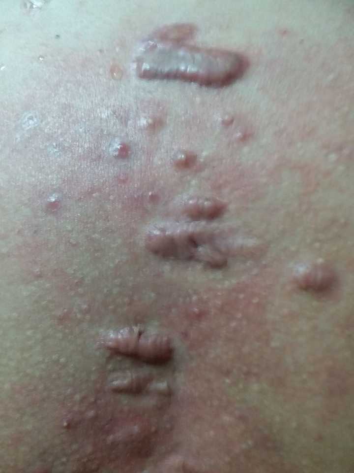 怎么去掉疤痕疙瘩啊?