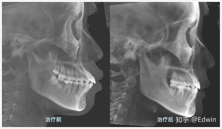 龅牙凸嘴怎么改善侧脸