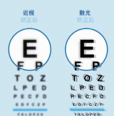 散光 原因:眼球不同方向屈光力不同,平行光线经眼屈光系统折射后 不