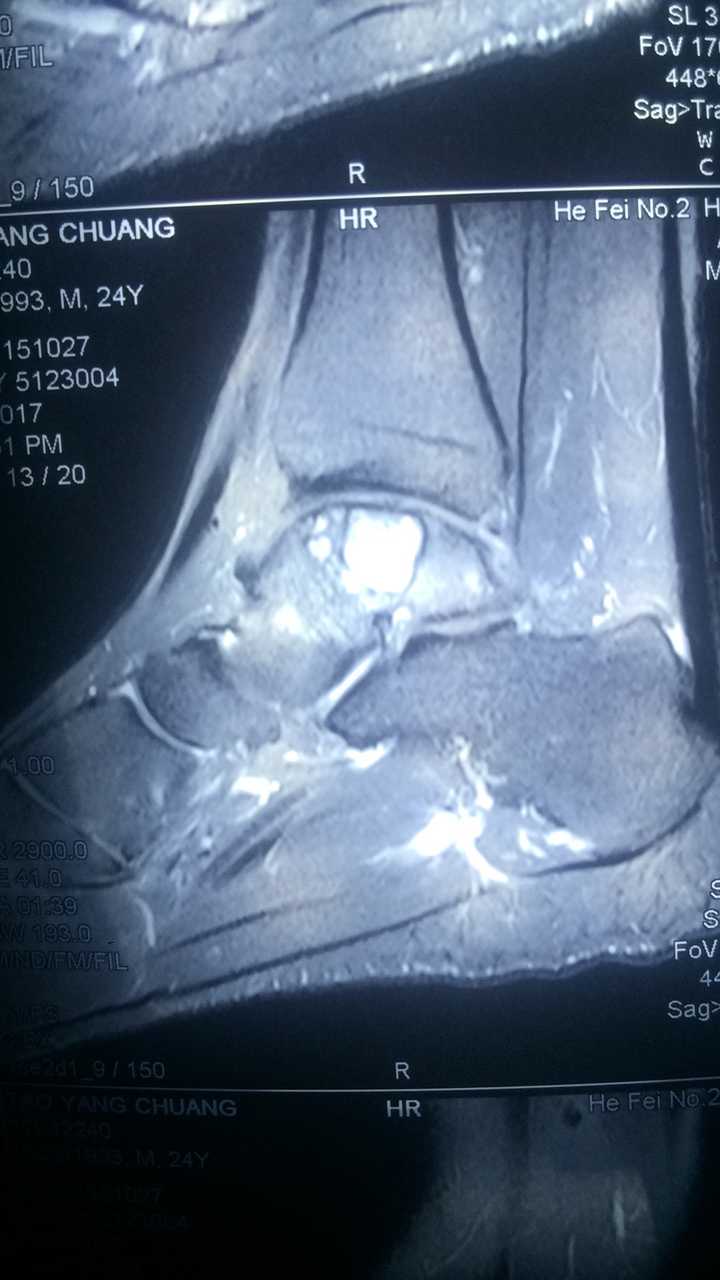 脚踝踝关节处有囊肿,一个月前手术,行植骨术 内固定术