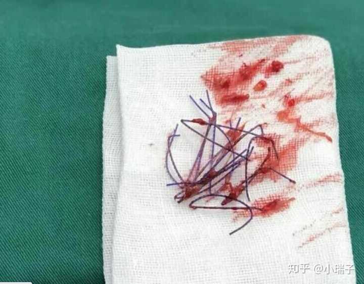 如今市面的注射隆鼻,假体隆鼻,线雕隆鼻,鼻综合等鼻整形技术之间有何