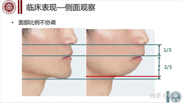 眉间点为面上份;自眉间点至鼻下点为面中份;自鼻下点至颏下点为面下份