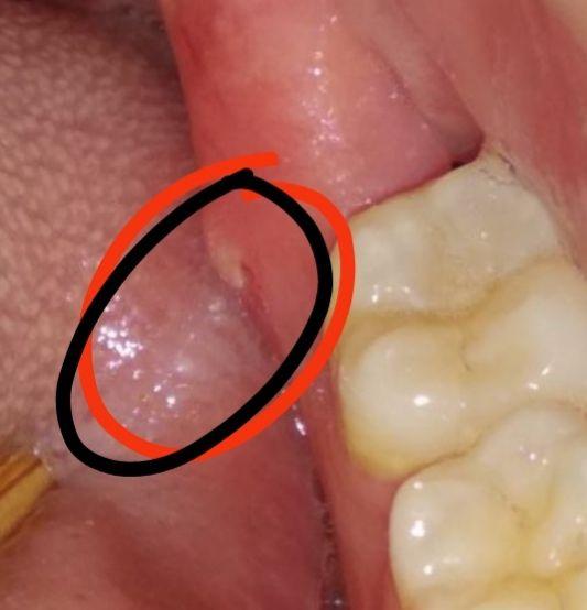 智齿拔完后两个月,牙洞那里长出小骨刺,怎么回事呢?