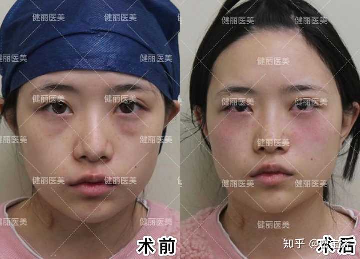 天生眼袋大黑眼圈重有怎样的体验
