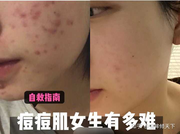 毒素大,肝功能不好什么的,开了一堆中药,我把中药当糖水喝,只为痘痘快
