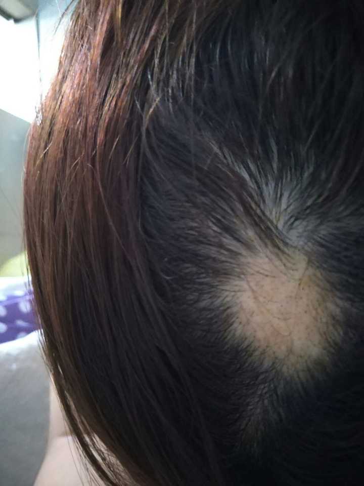 这个小小的短头发是长出来的吗?还是断的?斑秃是掉毛囊吗?