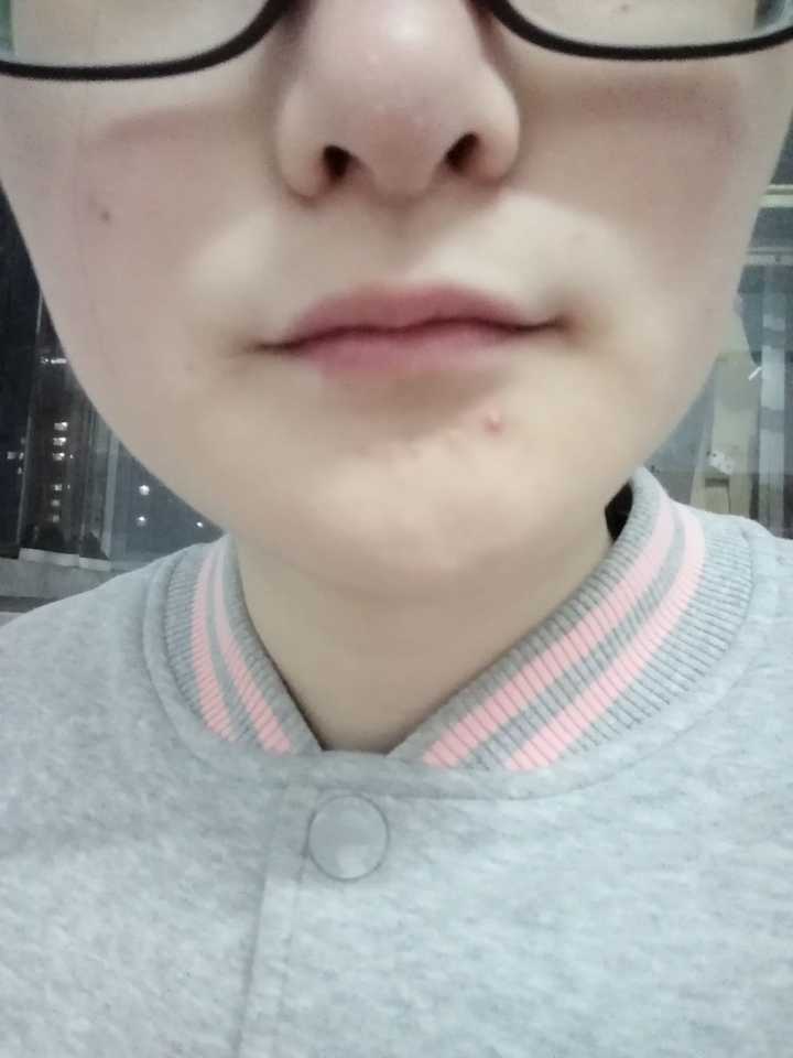 长期单侧咀嚼,导致一边脸大一边脸小,怎么恢复?