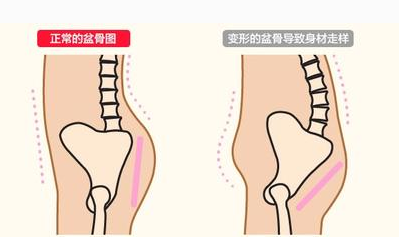 骨盆变形有多可怕