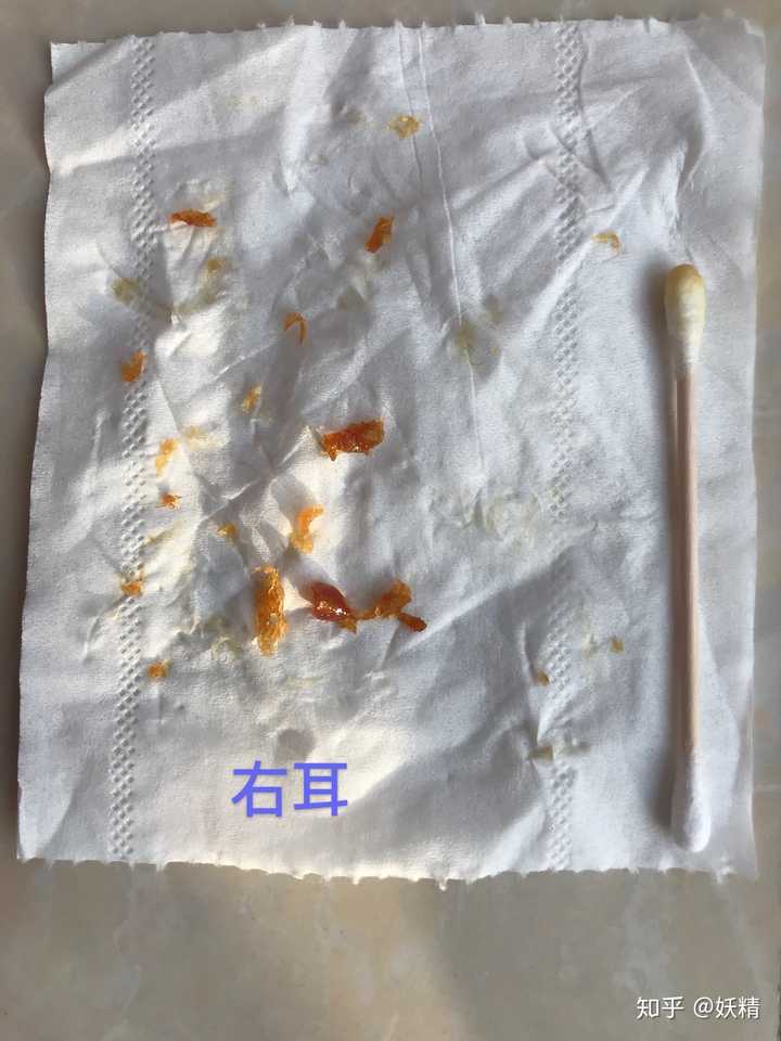 耳屎能大到什么程度?