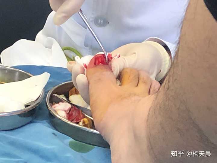 这是手术过程…没错 我就坐着拿手机拍