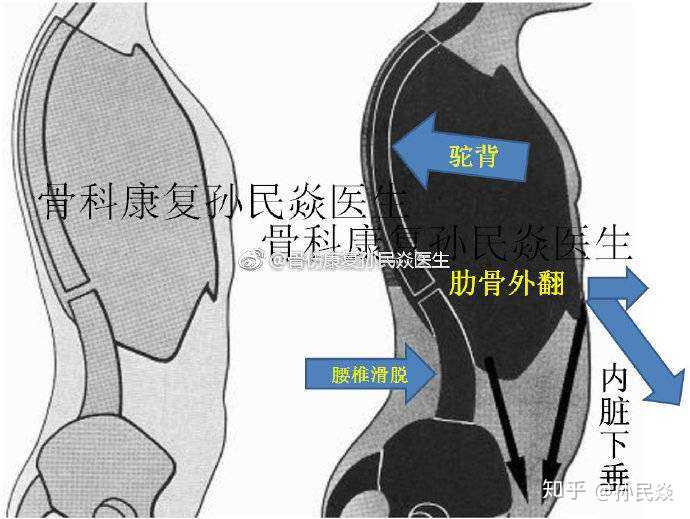 孙民焱 的想法: 肋骨外翻 驼背 腹部膨隆 骨盆前倾等体态… - 知乎