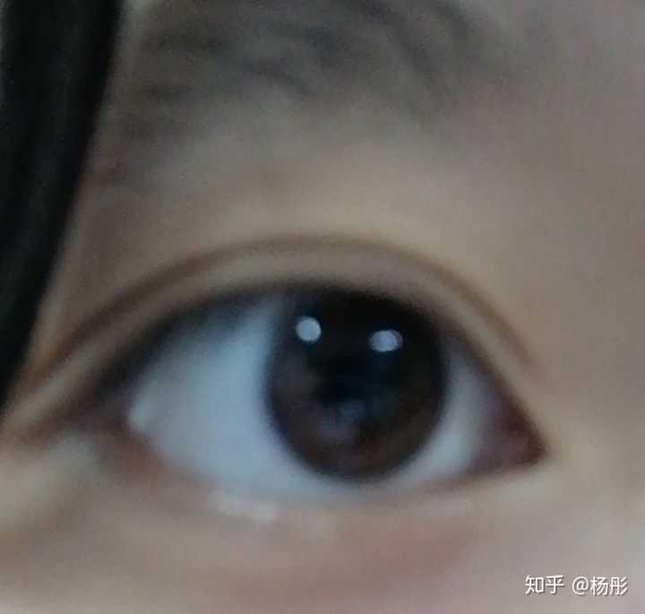 做过激光手术和飞秒的近视患者,之后的生活是怎样的?