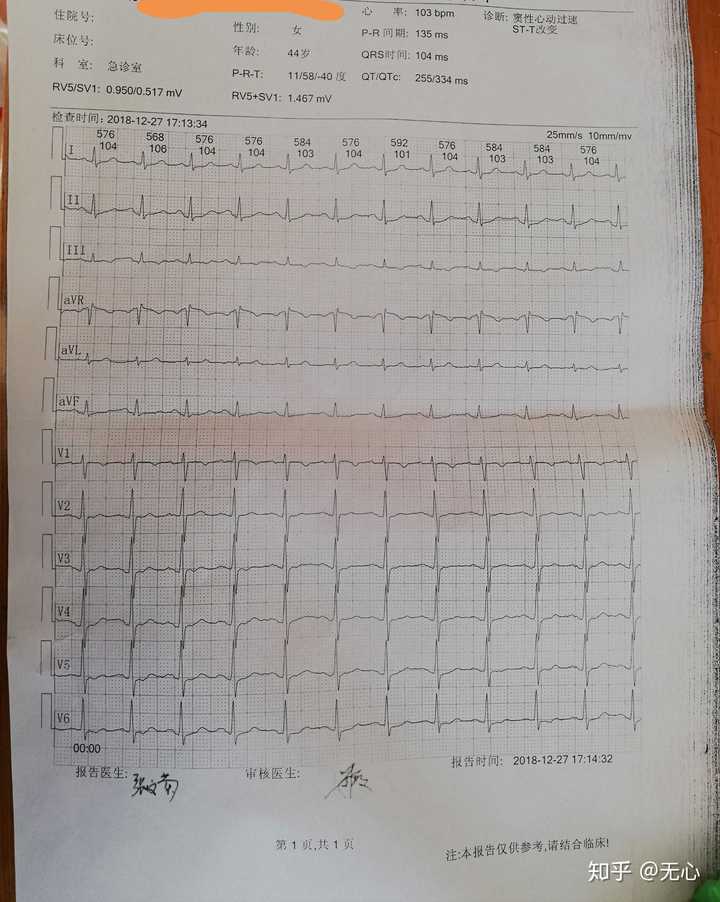 心电图结果为心肌缺血?