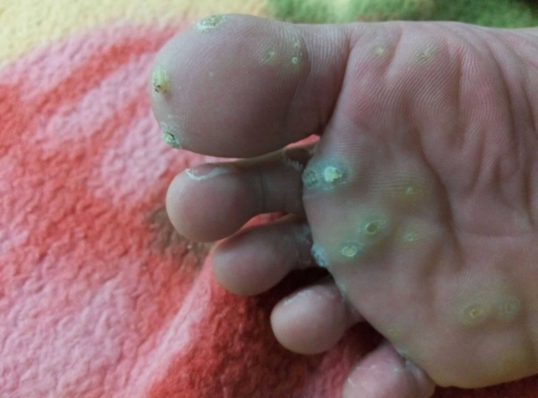 脚上的跖疣痊愈了!有同样问题的朋友不要气馁!