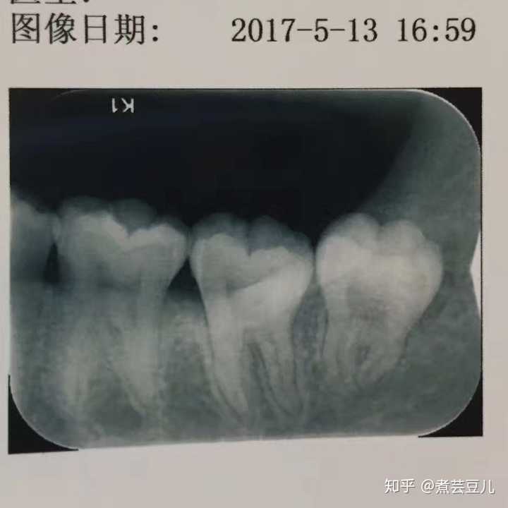 拔智齿有多痛?