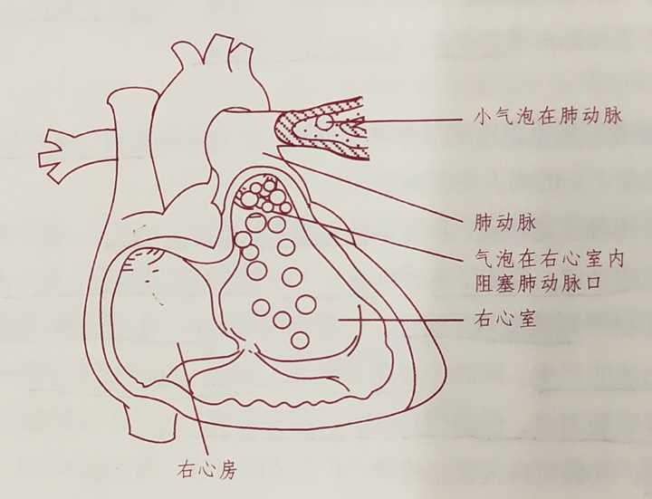 出现空气栓塞的临床表现