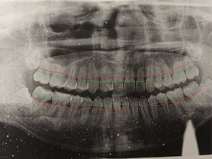 我大致画了一下牙槽骨的位置,绿线代表正常牙槽骨高度,红线是题主目前