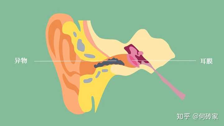 耳朵进异物怎么办?
