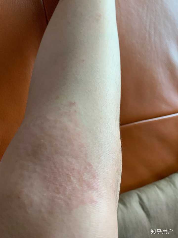 贴膏药过敏怎么办?