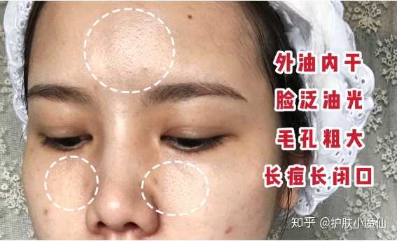 如何护理外油内干型皮肤?