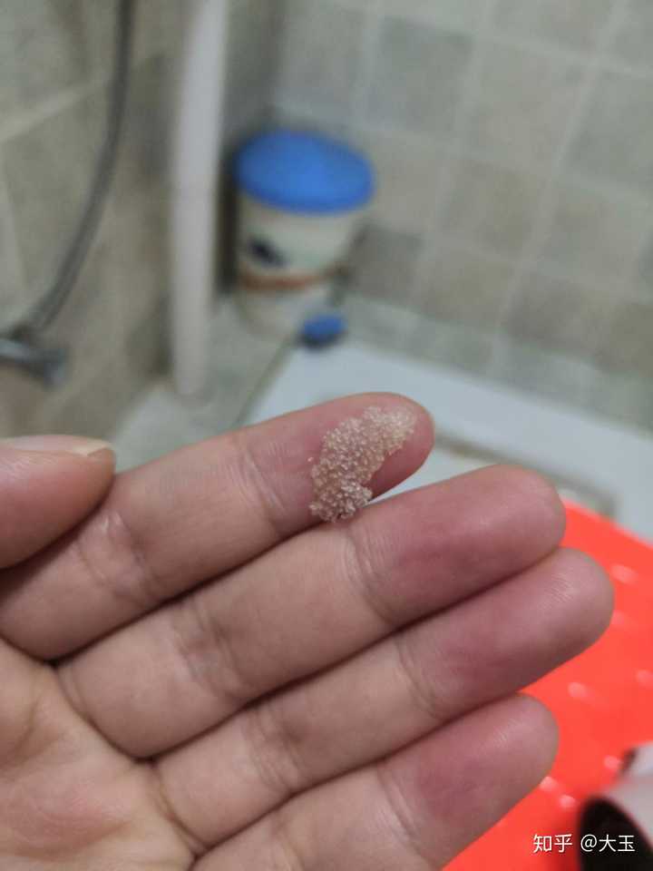 见过的最大头皮屑多大?