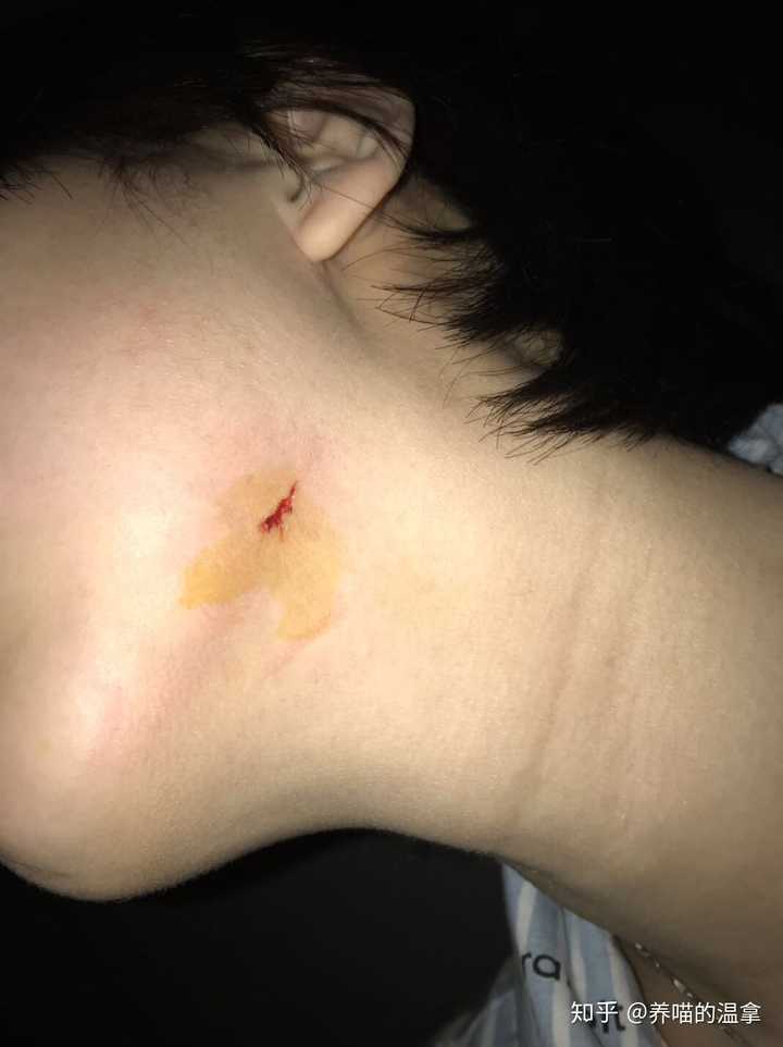 晒一晒你们家猫给你留下的哪些伤疤?