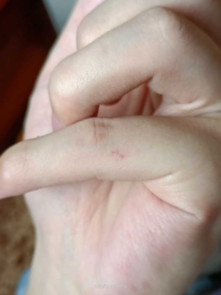 小手指上长个几个针眼那么小的红点,不疼不痒,按下会变淡,有人知道