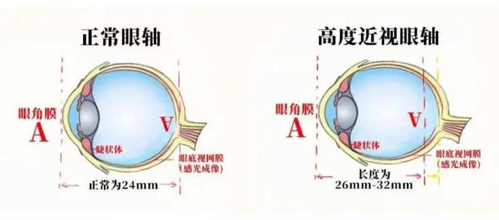 由于眼球扩张, 眼轴延长, 视网膜也随之扩张变薄, 赤道部及周边部网