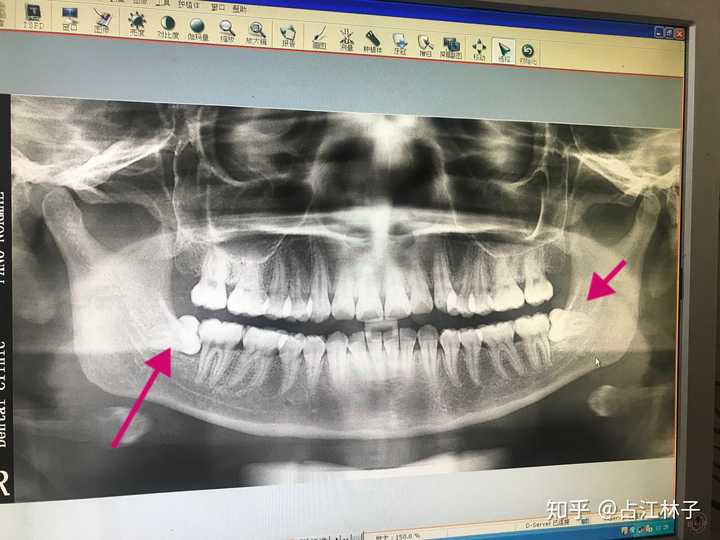 这是去年拔智齿前拍的片.