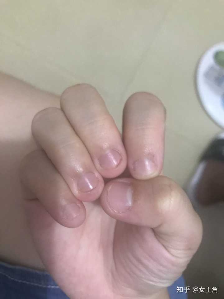 指甲很短而且很丑怎么办?