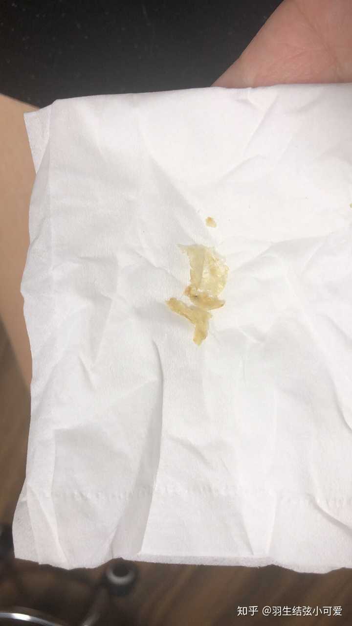 这是一只耳朵的 另一只被我爸嫌弃得扔了 说我有病,留这个耳屎干什么