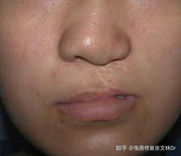 先天性兔唇的人在社会上都过得怎么样?