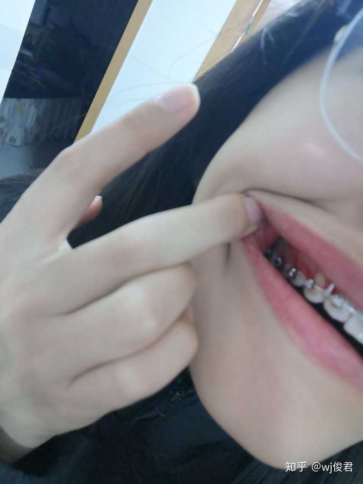 女生矫正牙齿是怎样一种体验?
