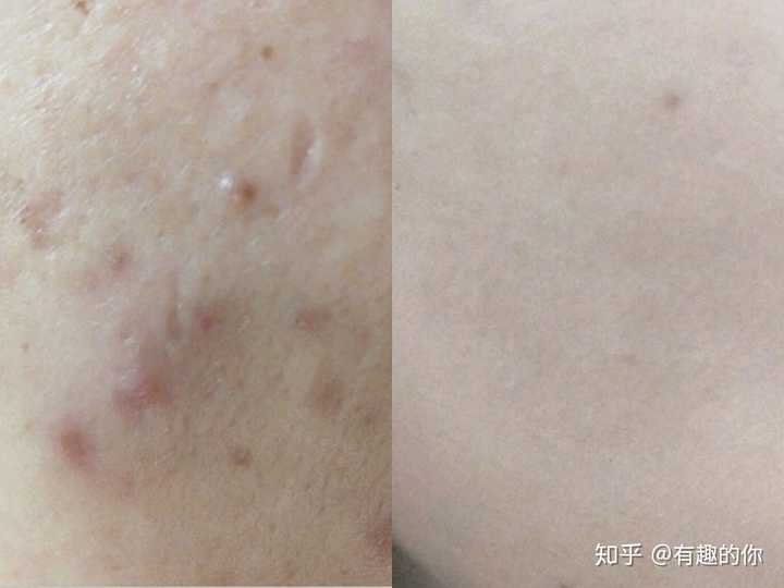 女生脸上毛孔粗大,有黑头,痘痘,怎么护肤?