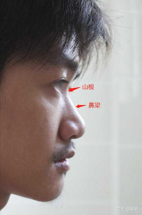 20岁 不整容 怎样让山根变高 除化妆之外?