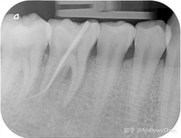 这是根尖片,是用来看牙根的根尖部位的