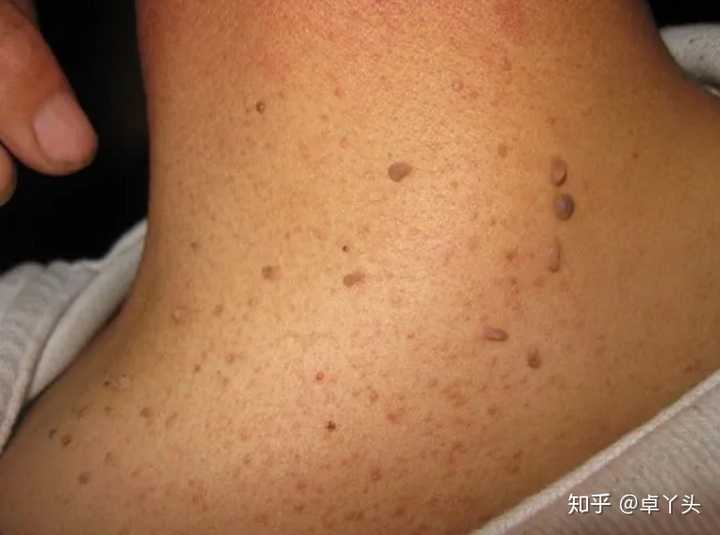 脖子上长疣,主要是感染人乳头瘤病毒(hpv)造成的.