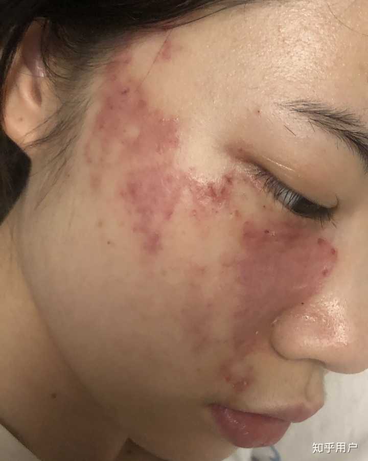 脸上有胎记是一种怎样的体验?