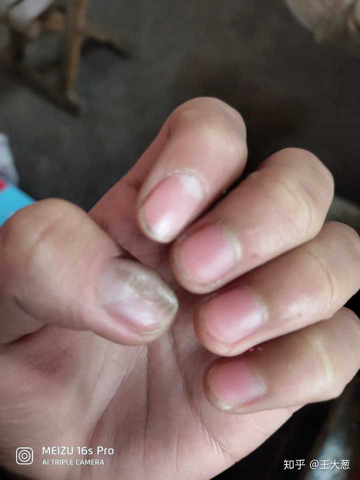 拇指指甲盖凹凸不平,很多横纹.这是什么问题?
