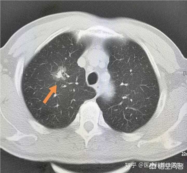 例如下图胸部ct发现的早期肺癌,胸片肯定是看不到的.