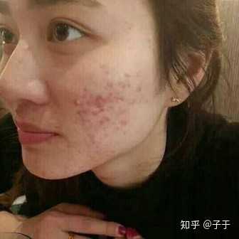 痘痘脸 知乎