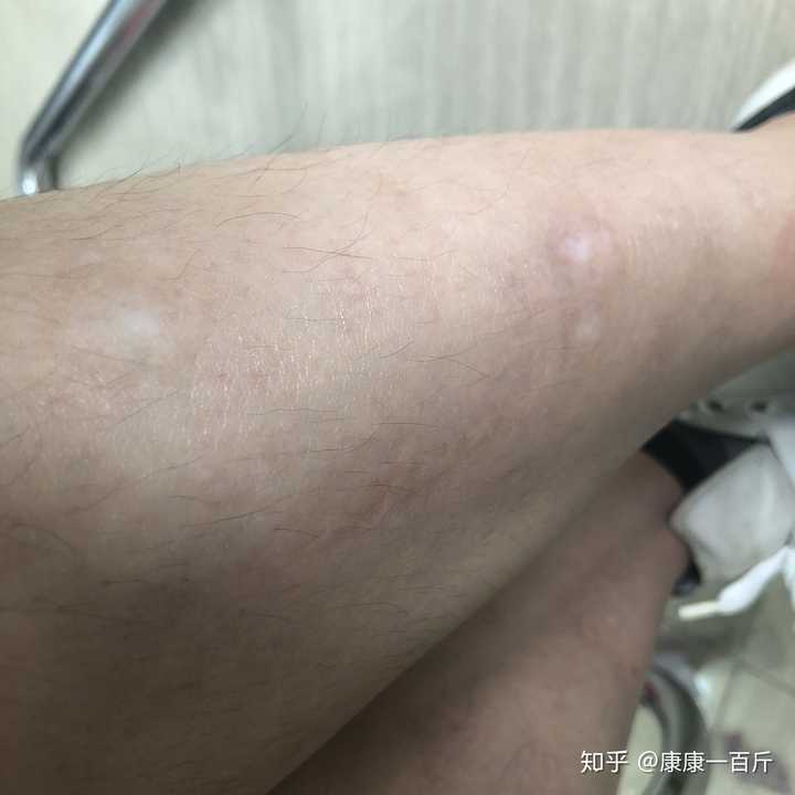 小时候被开水烫伤现在想祛疤有没有比较好的医院推荐一下?