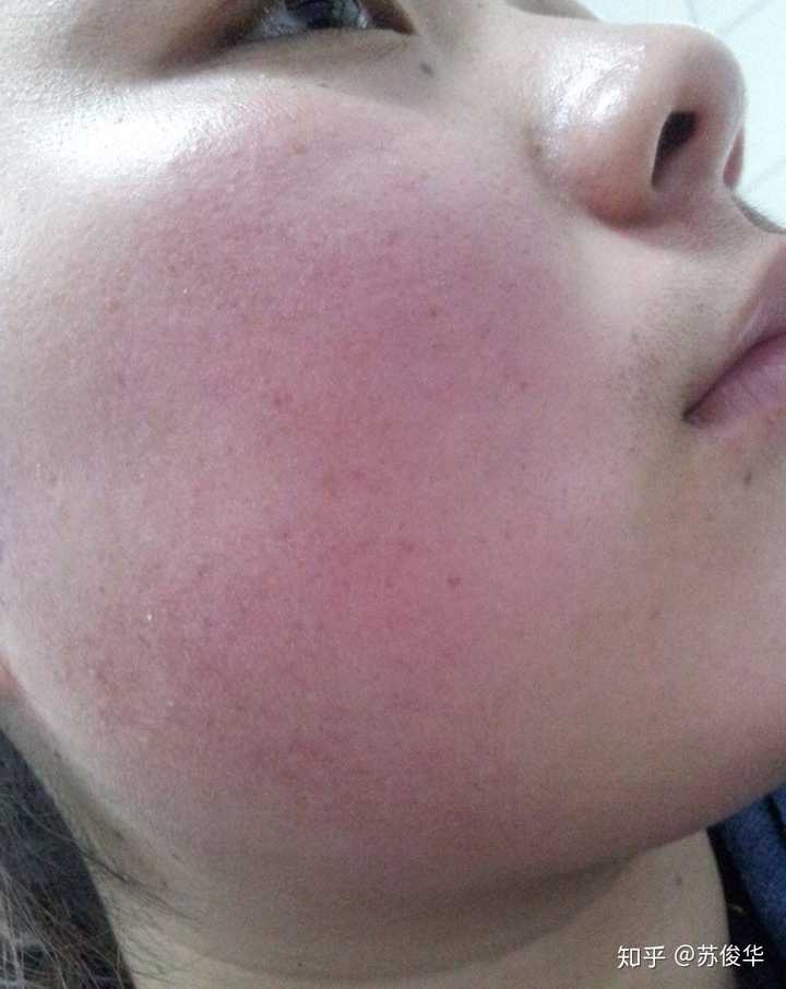 过敏性皮炎,应该如何处理?