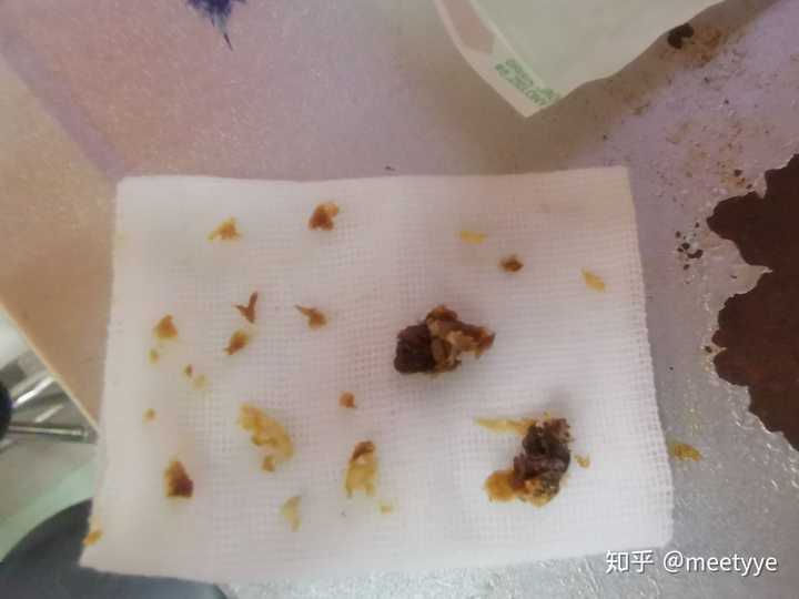 耳屎能大到什么程度?