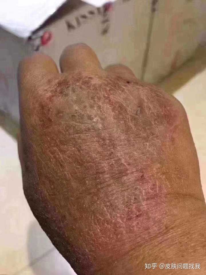 手部湿疹能根治吗?