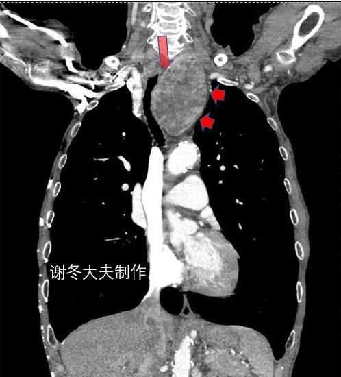 谢大夫,这个前纵隔占位,是胸腺瘤吗?