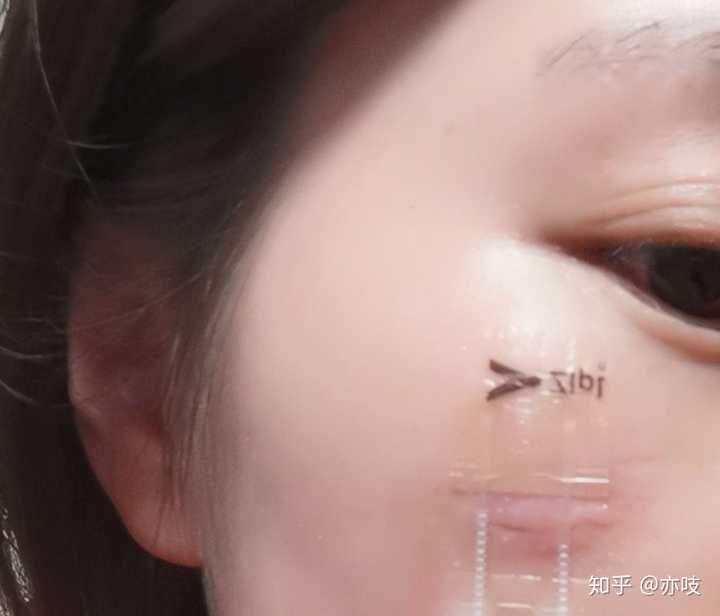 不小心摔倒磕到脸上了,立马去九院用美容针缝合的.
