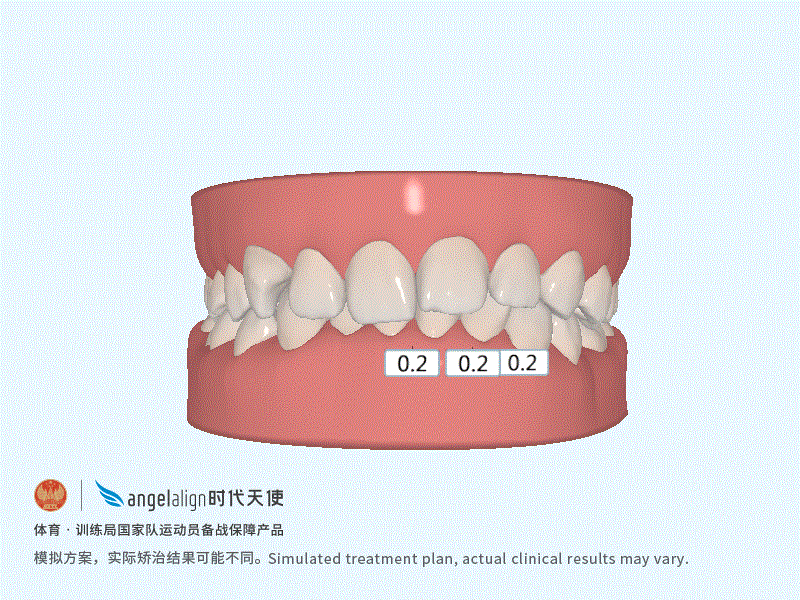 这是我的方案~动图里的粉色附件现实中是白色 如果你的牙齿调整幅度