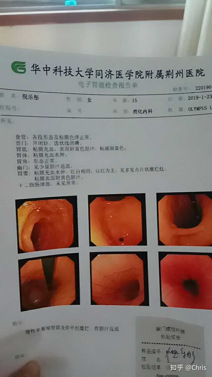 做胃镜是一种怎样的体验?