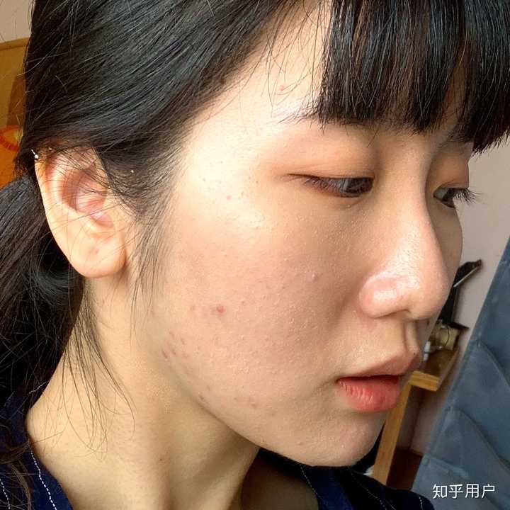 怎么看待五官漂亮但是皮肤差的女性?